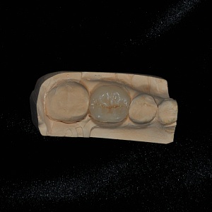 3. E.max inlay (46 зуб)