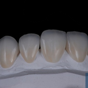 Emax