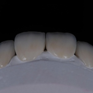 Emax
